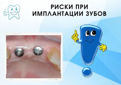 Имплантация зубов верхней челюсти в Москве под ключ недорого, цены от  ДантистоФФ
