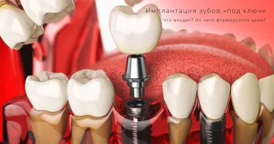 Имплантация зубов под ключ VIP уровня в ТОП 1 клиниках Москвы - Немецкий  имплантологический центр