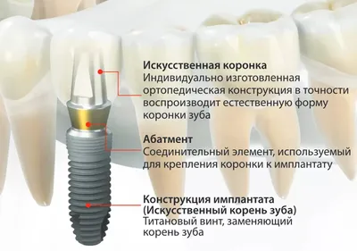 Имплантация зубов под ключ в Челябинске - цены и акции на зубные импланты