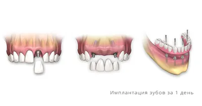 Имплантация зубов под ключ в Москве [цена от 35 500 ₽]