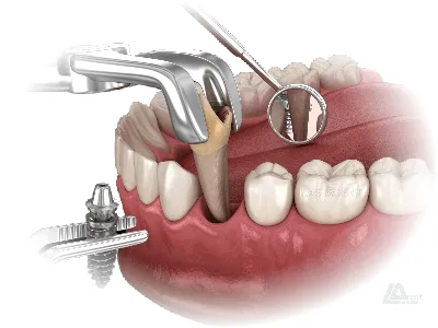Имплантация зубов виды и цены - Cтоматология Май