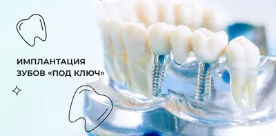 Кейсы стоматологических имплантаций: фото до и после в клиниках Чистое  Дыхание СПб