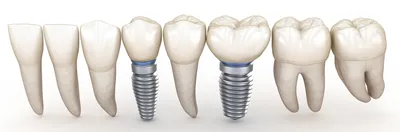 Плюсы и минусы имплантации зубов — честный обзор от хирурга-имплантолога