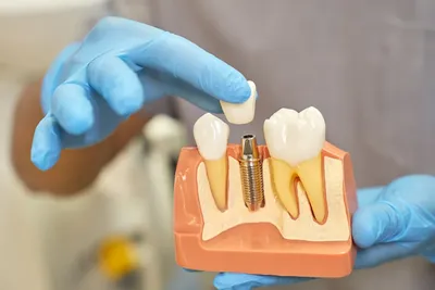 Имплантация зубов за 1 день • Имплантмастер