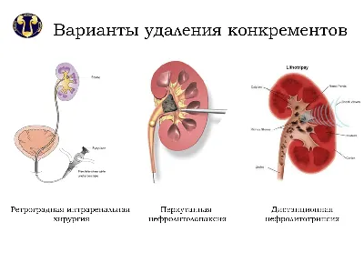 Камни в почках (нефролитиаз) - симптомы, причины, лечение, признаки