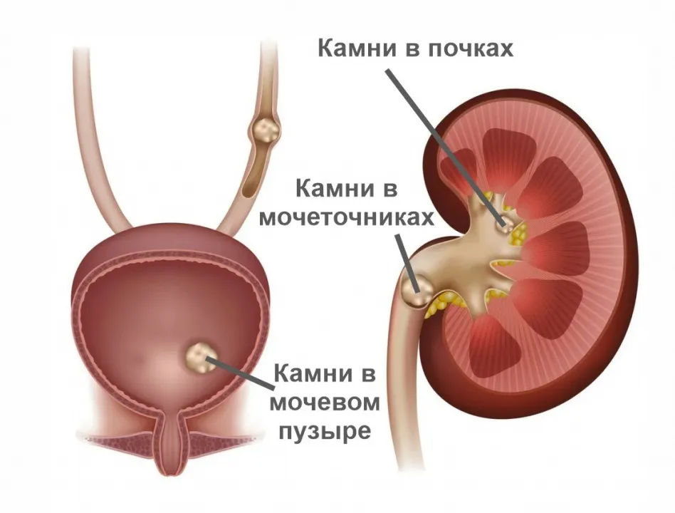 Камни в почках код