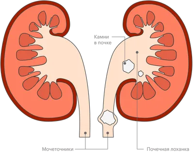 Как удалить камни в почке