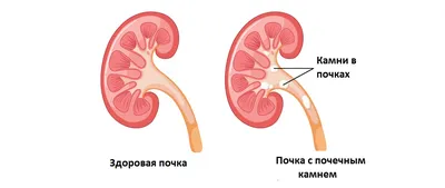 Камень в почке лечение по низкой цене в Индии