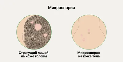 Все о кандидозе и его лечении — кандидоз кожи, полости рта и не только –  что делать | О здоровье: с медицинского на русский | Дзен