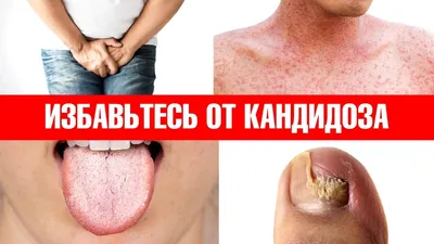 Грибок кожи головы симптомы и лечение - Dr. Levent Acar