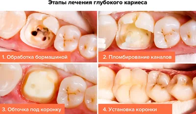 Вторичный кариес - Терапевтическая стоматология - «Аксиома Дентал»