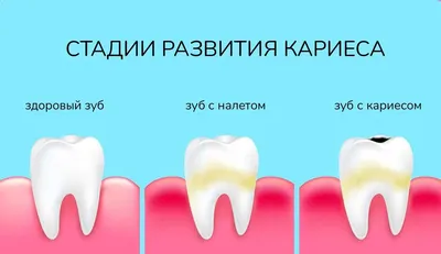 Как предотвратить кариес? | стоматология Рица