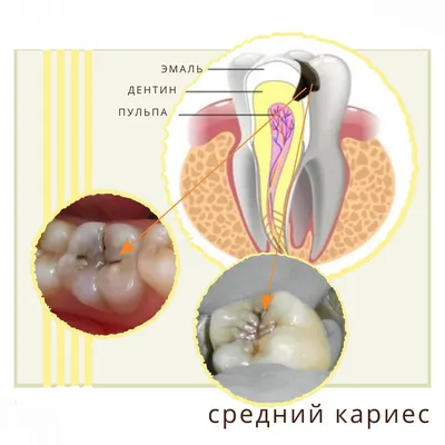 Лечение кариеса в стоматологической клинике \"Доктор Про\"