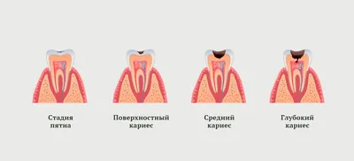 COViD-19 и кариес зубов