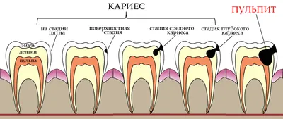 Лечение кариеса | Luxsmile