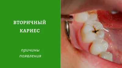 Лечение кариеса в городе Раменское цена от 1600 руб - «New Smile»