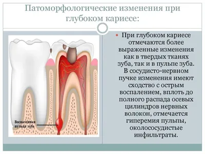 Глубокий кариес - Терапевтическая стоматология - «Аксиома Дентал»