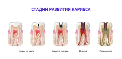 Кариес у детей (лечение в Киеве, цены) - фото, причины