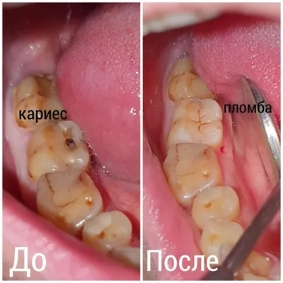 Генерализованный кариес