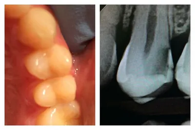 Лечение кариеса | Стоматология в Запорожье Dental Studio