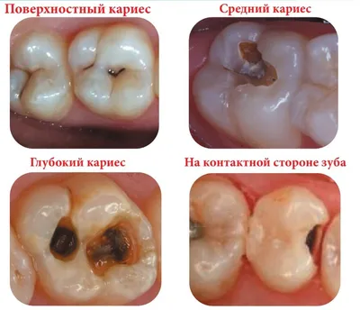 Чем опасен запущенный кариес?