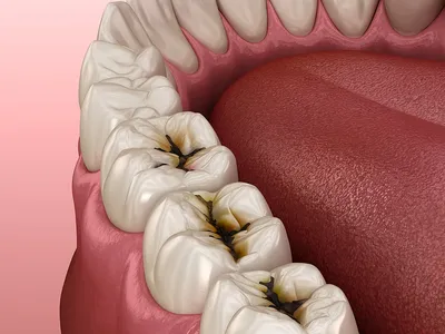 Апроксимальный кариес — сложности в выявлении и профилактике — Эстетическая  стоматология Deva-Dent в Москве