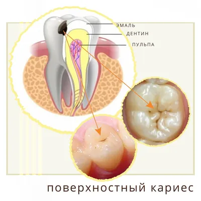 Средний кариес - стоимость услуги Кариес у взрослых в Киеве, Средний кариес  - цена в стоматологии lipinskii.com.ua