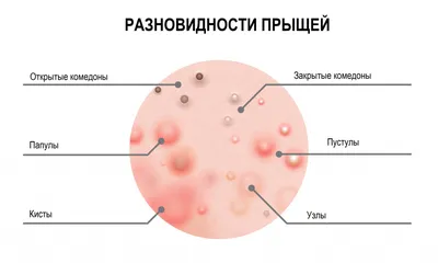 Прыщи на лице: причины и лечение