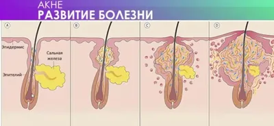 На что указывают прыщи на той или иной области лица