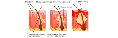 Подкожные прыщи: как избавиться, причины появления закрытых комедонов на  коже, препараты от заболевания, лечение акне и угревой сыпи