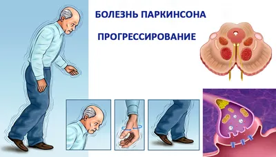 Болезнь Паркинсона - ГБУЗ «Белореченская ЦРБ» МЗ КК