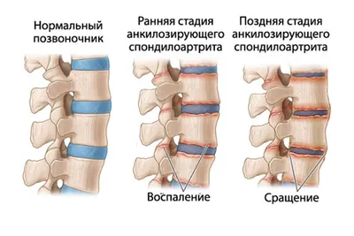 Болезнь Меньера симптомы, признаки, лечение - Мегаптека