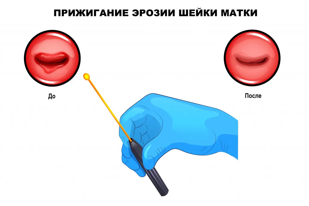 Свечи после прижигания эрозии