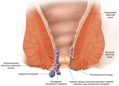 Внутренний геморрой: симптомы заболевания, признаки, стадии развития,  лечение