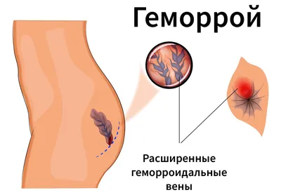 Лечение Геморроя