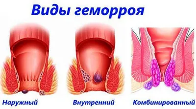 Лечение геморроя без операции методом катетеризации - ENDORAD