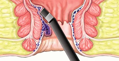 Геморрой – причины, симптомы, диагностика и способы лечения заболевания |  Клиника Будь Здоров