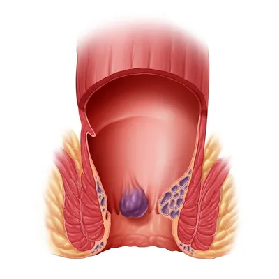 Причины возникновения геморроя, способы лечения гемороя