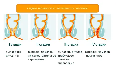 Геморрой: симптомы и причины возникновения — Медицинский центр Integro  Черкассы