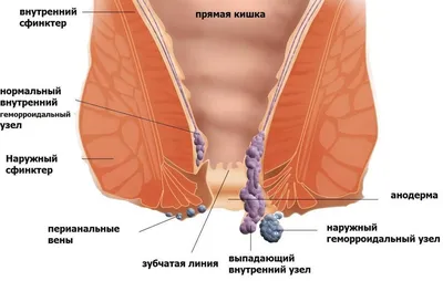 Геморрой: лечение, симптомы, причины, виды профилактика, последствия и  диагностика заболевания