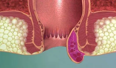 Наружный (внешний) геморрой: симптомы, как выглядит, что делать, лечение,  профилактика