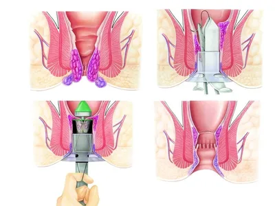 Наружный геморрой - причины и методы лечения