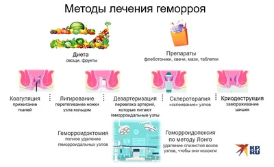 Геморрой у мужчин и женщин - суть проблемы, причины, симптомы, стадии,  лечение | Mednavigator.ru | Дзен