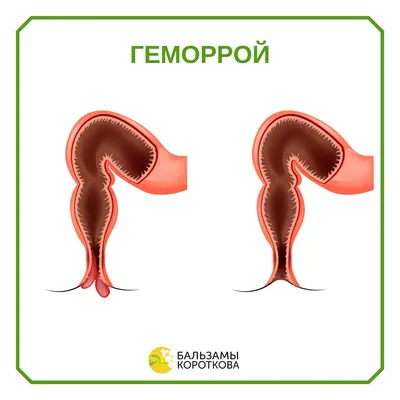 Геморрой при беременности - Иркутский городской перинатальный центр имени  Малиновского М.С.