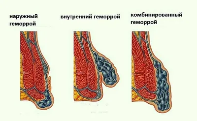 Геморрой