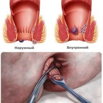 Геморрой - симптомы, лечение, причины и профилактика геморроя - Гармония