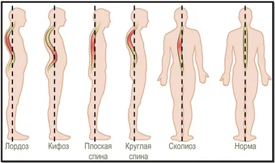 ЛФК, Реабилитация в Шымкенте - Сколиоз — это искривление позвоночника  вправо или влево относительно своей оси. Чаще всего встречаются сколиозы  грудного и поясничного отделов позвоночника. Сколиоз - это асимметрия тела,  не только