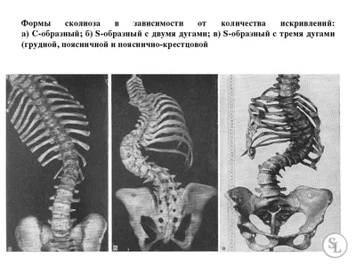 до и после кифоза. мужчина страдает от искривления позвоночника в верхней  части. выпуклость шейного позвонка Стоковое Фото - изображение  насчитывающей обжатие, болгарской: 217368814