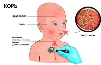 Профилактика кори (памятка для населения). — mon-crb