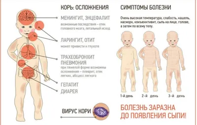 ОГБПОУ \"Томский колледж гражданского транспорта\" - Корь. Профилактика кори